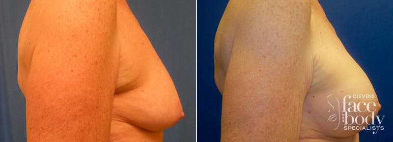 Hidden Breast Aug and Lift Before & After Gallery - Patient 115144 - Image 2