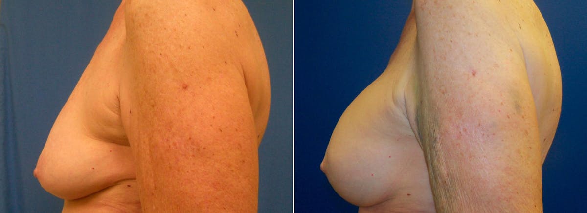 Hidden Breast Aug and Lift Before & After Gallery - Patient 699949 - Image 3