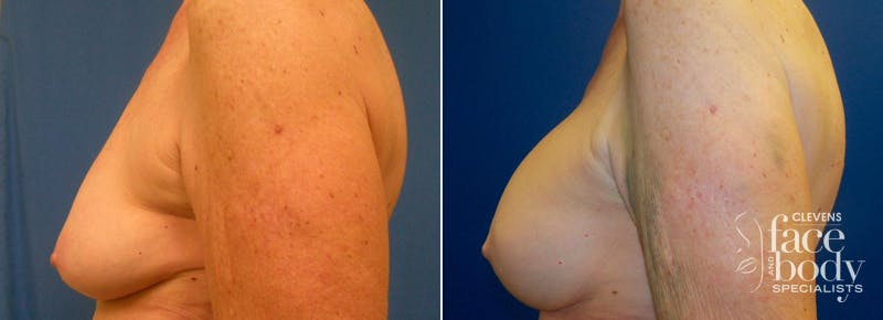 Hidden Breast Aug and Lift Before & After Gallery - Patient 115144 - Image 3