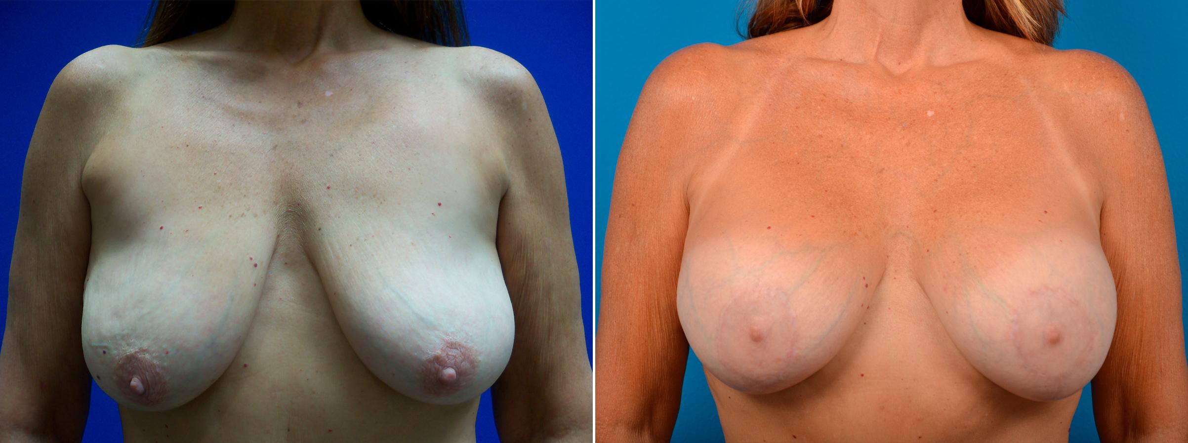Hidden Breast Aug and Lift Before & After Gallery - Patient 210843 - Image 1