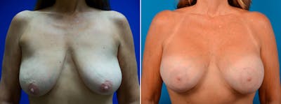 Breast Augmentation and Lift Before & After Gallery - Patient 122405389 - Image 1