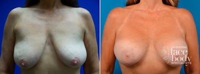 Hidden Breast Aug and Lift Before & After Gallery - Patient 210843 - Image 1