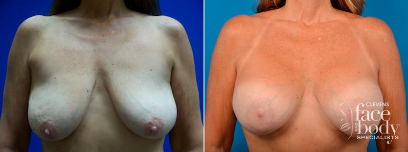 Hidden Breast Aug and Lift Before & After Gallery - Patient 167858 - Image 1