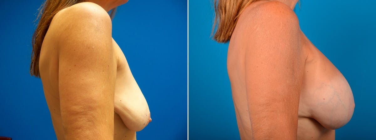 Hidden Breast Aug and Lift Before & After Gallery - Patient 210843 - Image 2