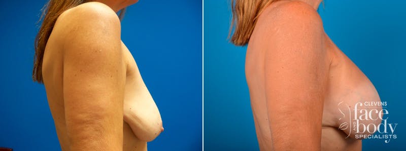 Hidden Breast Aug and Lift Before & After Gallery - Patient 167858 - Image 2