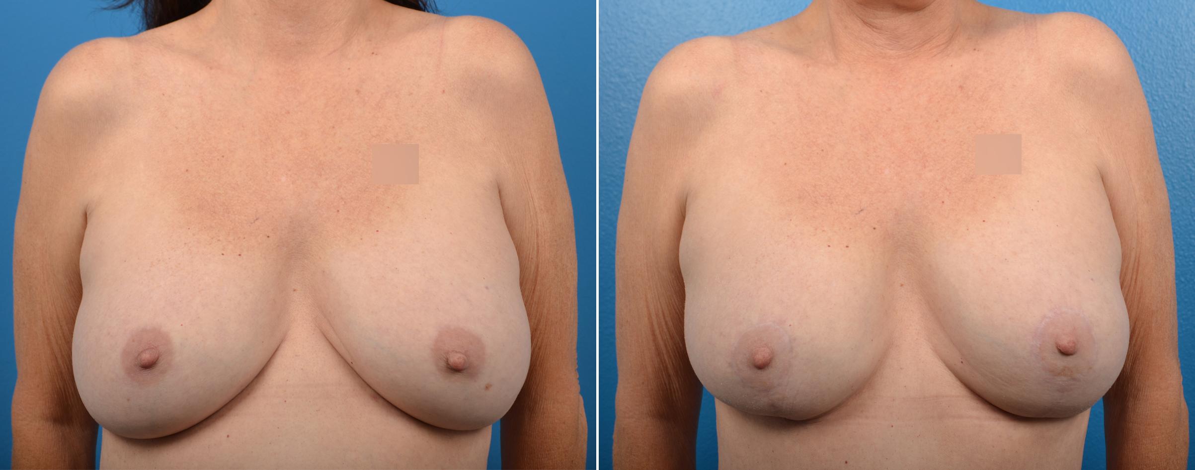 Hidden Breast Aug and Lift Before & After Gallery - Patient 169042 - Image 1