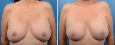 Breast Augmentation and Lift Before & After Gallery - Patient 319266 - Image 1