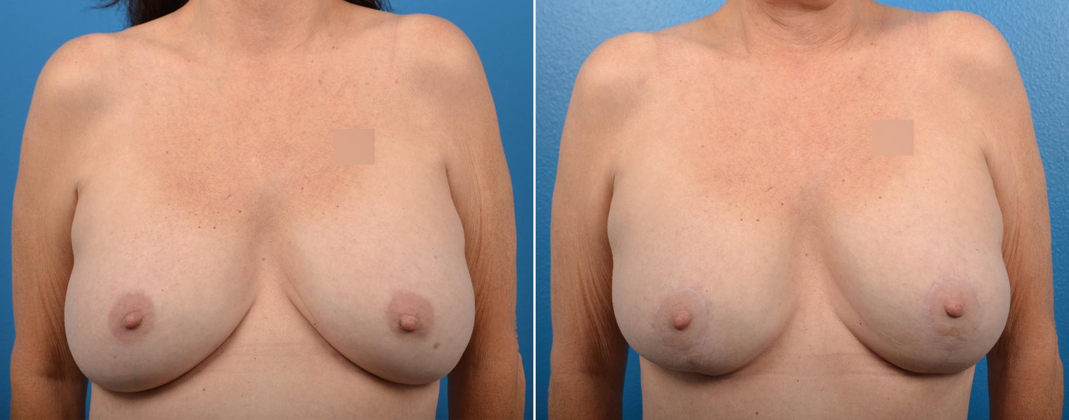 Breast Augmentation and Lift Before & After Gallery - Patient 122405390 - Image 1