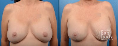 Hidden Breast Aug and Lift Before & After Gallery - Patient 169042 - Image 1