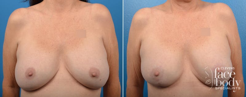 Hidden Breast Aug and Lift Before & After Gallery - Patient 234884 - Image 1