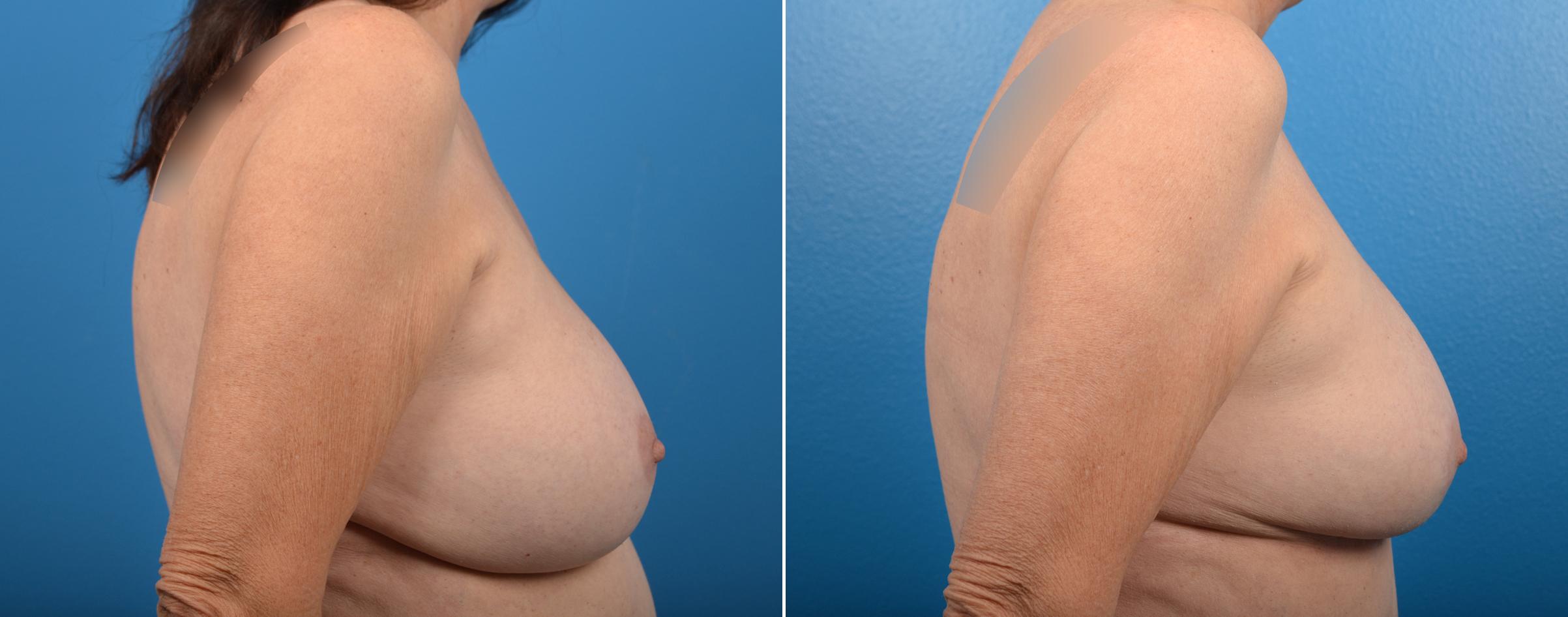 Hidden Breast Aug and Lift Before & After Gallery - Patient 169042 - Image 2