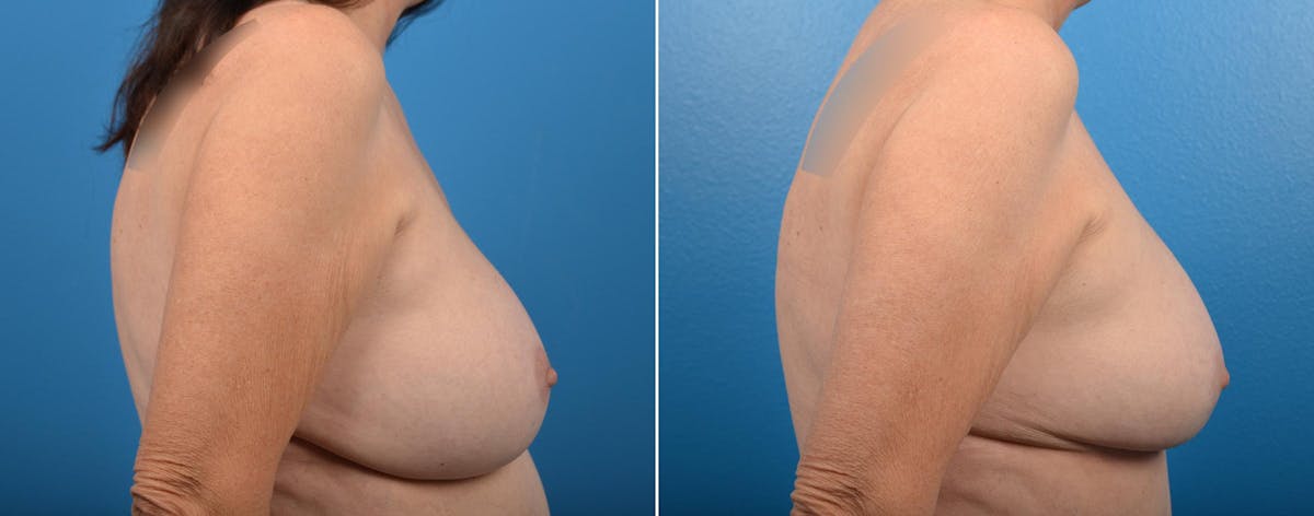 Breast Augmentation and Lift Before & After Gallery - Patient 319266 - Image 2