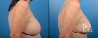 Hidden Breast Aug and Lift Before & After Gallery - Patient 234884 - Image 2