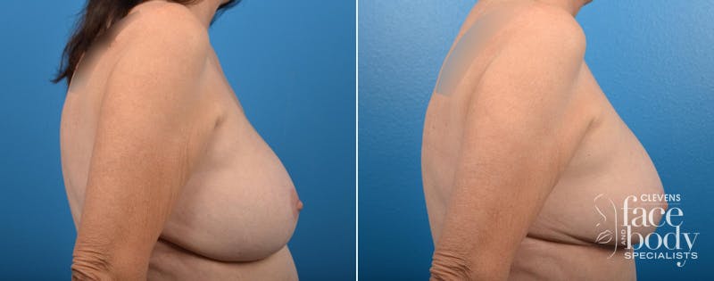 Hidden Breast Aug and Lift Before & After Gallery - Patient 234884 - Image 2