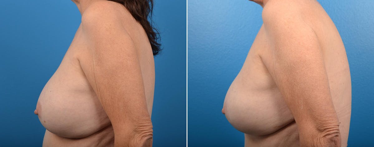 Hidden Breast Aug and Lift Before & After Gallery - Patient 169042 - Image 3
