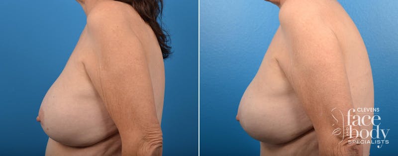 Hidden Breast Aug and Lift Before & After Gallery - Patient 234884 - Image 3