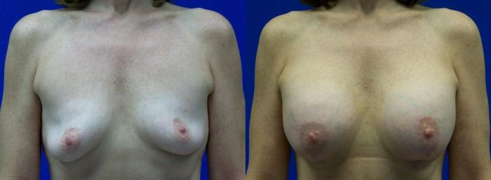 Hidden Breast Aug and Lift Before & After Gallery - Patient 270781 - Image 1