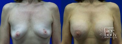 Hidden Breast Aug and Lift Before & After Gallery - Patient 270781 - Image 1