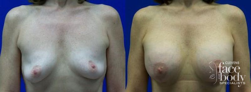 Hidden Breast Aug and Lift Before & After Gallery - Patient 159124 - Image 1