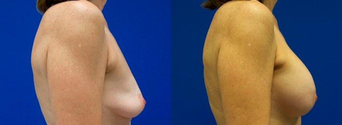 Hidden Breast Aug and Lift Before & After Gallery - Patient 159124 - Image 2