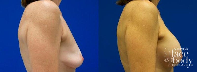 Hidden Breast Aug and Lift Before & After Gallery - Patient 159124 - Image 2