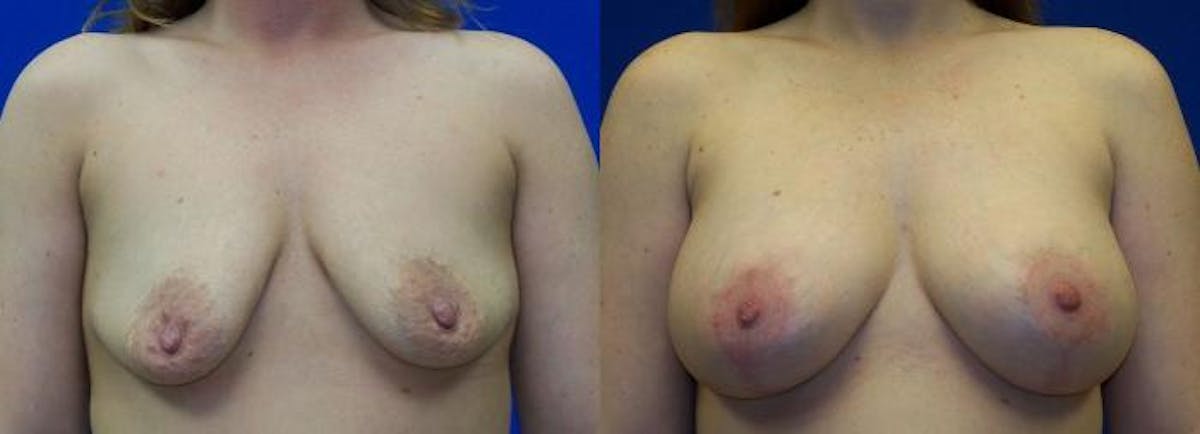 Breast Augmentation and Lift Before & After Gallery - Patient 571992 - Image 1