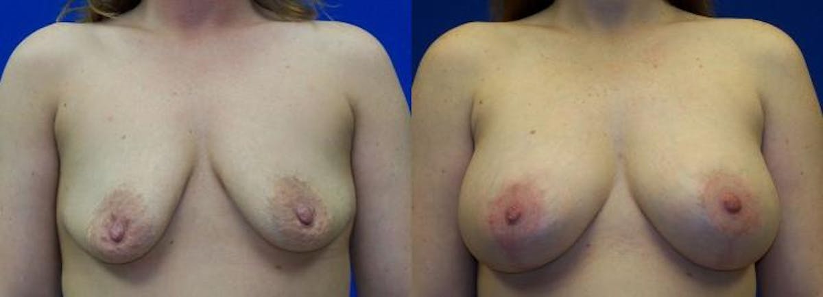 Hidden Breast Aug and Lift Before & After Gallery - Patient 631852 - Image 1