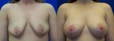 Hidden Breast Aug and Lift Before & After Gallery - Patient 105717 - Image 1