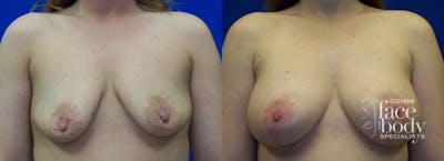 Hidden Breast Aug and Lift Before & After Gallery - Patient 105717 - Image 1