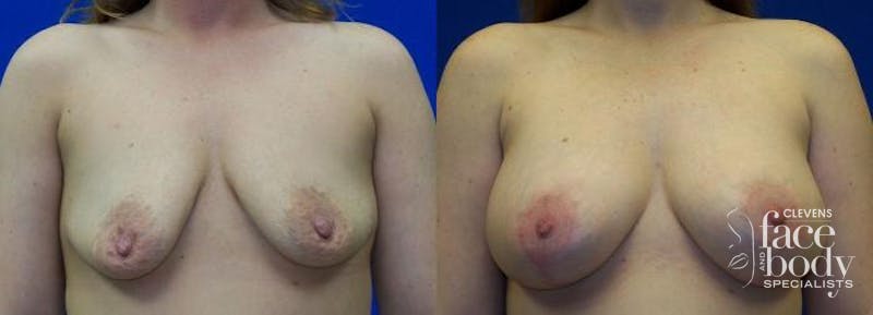 Hidden Breast Aug and Lift Before & After Gallery - Patient 631852 - Image 1