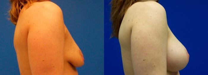 Hidden Breast Aug and Lift Before & After Gallery - Patient 105717 - Image 2