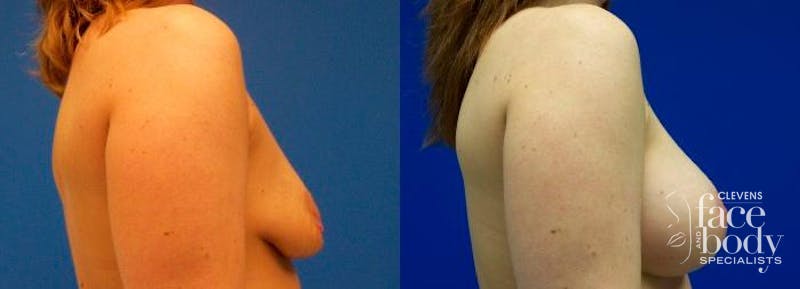 Hidden Breast Aug and Lift Before & After Gallery - Patient 631852 - Image 2