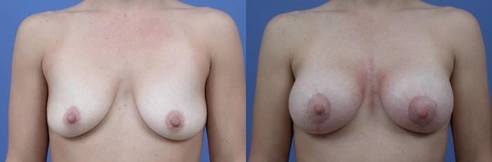 Hidden Breast Aug and Lift Before & After Gallery - Patient 245616 - Image 1