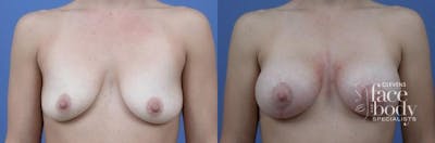 Hidden Breast Aug and Lift Before & After Gallery - Patient 245616 - Image 1
