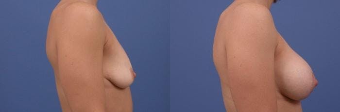 Breast Augmentation and Lift Before & After Gallery - Patient 122405394 - Image 2