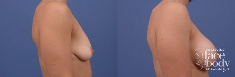 Hidden Breast Aug and Lift Before & After Gallery - Patient 245616 - Image 2