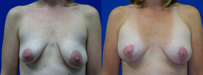 Hidden Breast Aug and Lift Before & After Gallery - Patient 345296 - Image 1