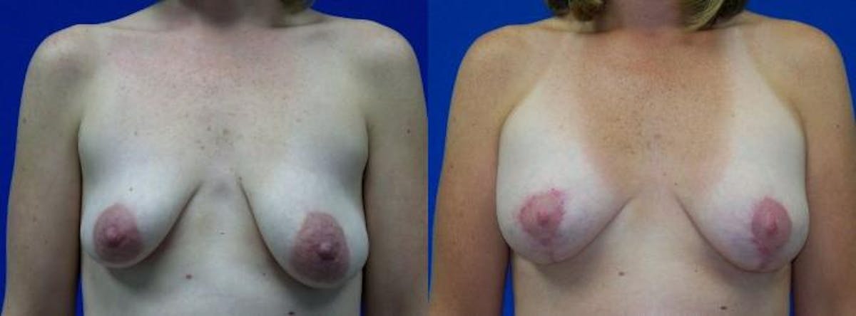 Breast Augmentation and Lift Before & After Gallery - Patient 380926 - Image 1