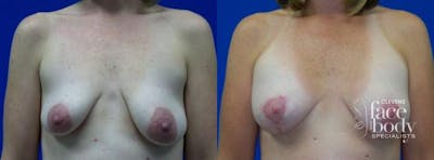 Hidden Breast Aug and Lift Before & After Gallery - Patient 345296 - Image 1