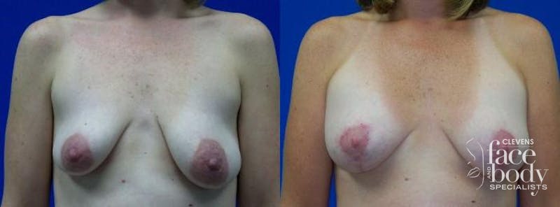 Hidden Breast Aug and Lift Before & After Gallery - Patient 345296 - Image 1