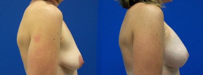 Hidden Breast Aug and Lift Before & After Gallery - Patient 345296 - Image 2