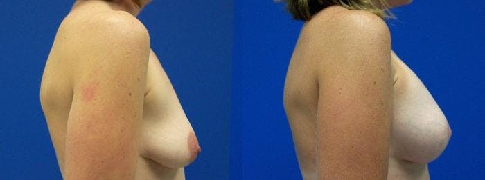 Breast Augmentation and Lift Before & After Gallery - Patient 122405396 - Image 2