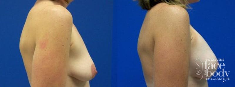 Hidden Breast Aug and Lift Before & After Gallery - Patient 345296 - Image 2