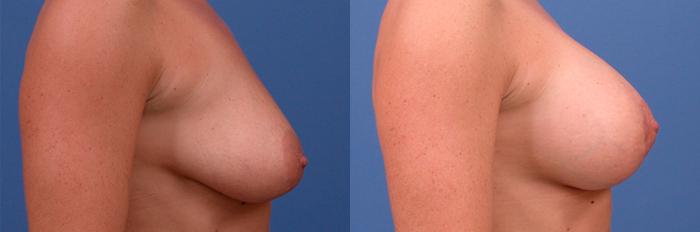 Hidden Breast Aug and Lift Before & After Gallery - Patient 371670 - Image 1