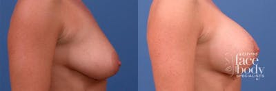Hidden Breast Aug and Lift Before & After Gallery - Patient 371670 - Image 1
