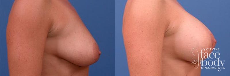 Hidden Breast Aug and Lift Before & After Gallery - Patient 146354 - Image 1