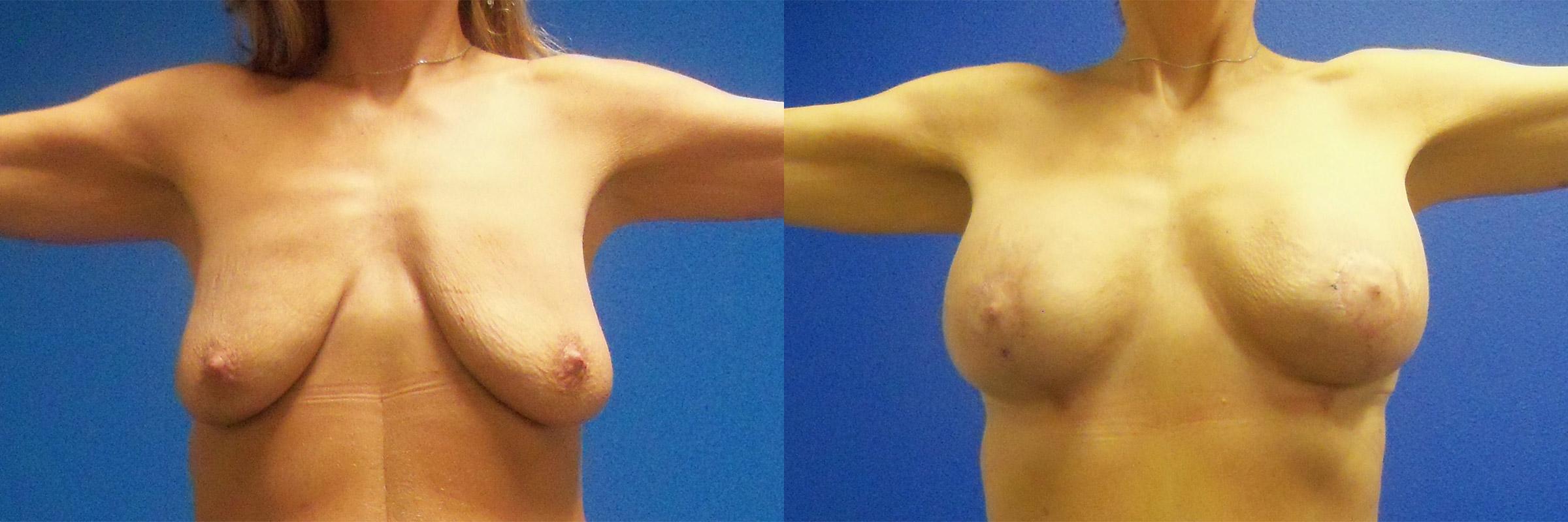 Hidden Breast Aug and Lift Before & After Gallery - Patient 382566 - Image 1