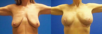 Breast Augmentation and Lift Before & After Gallery - Patient 122405399 - Image 1