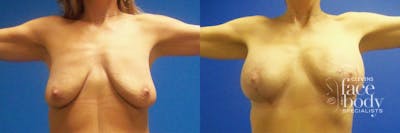 Hidden Breast Aug and Lift Before & After Gallery - Patient 382566 - Image 1