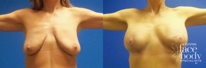 Hidden Breast Aug and Lift Before & After Gallery - Patient 382566 - Image 1